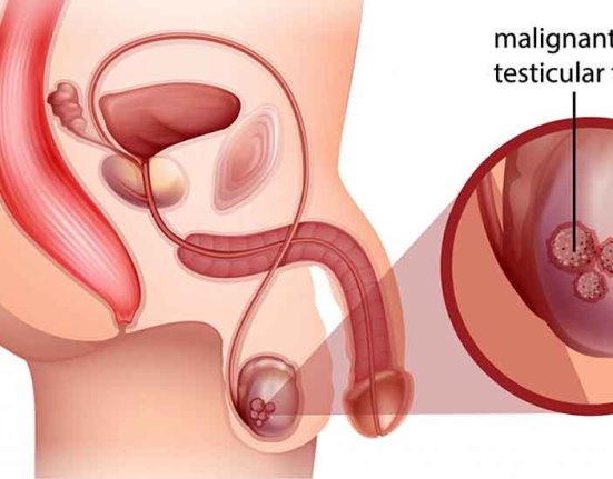 Early Signs of Prostate Cancer in Men